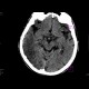 Ischemia, temporal lobe, third CT: CT - Computed tomography